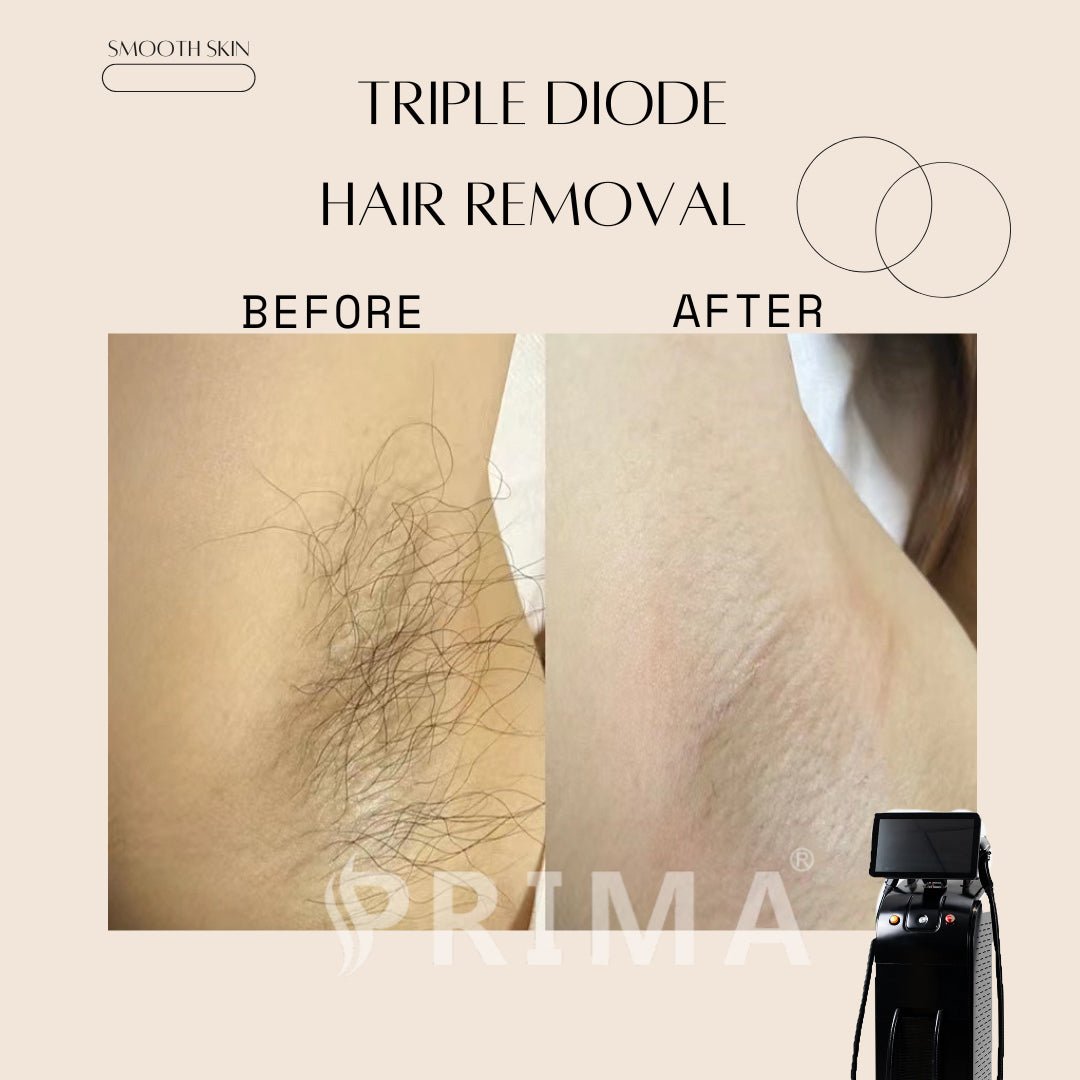 Wholesale Prices 800W 3 Wavelengths Diode Laser 755 808 1064 Ice Cooling System of Hair Removal Epilation Laser Spa Equipment