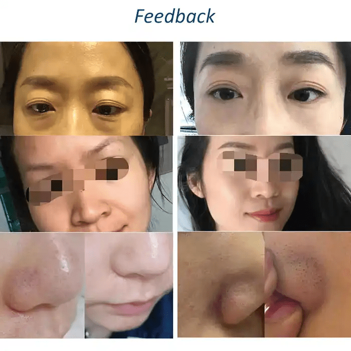 Newest Smart Ice Blue 7 in 1 Water Hidra Oxygen Diamond Dermabrasion Facial Machine With Skin Analysis